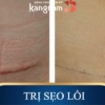 Hiệu quả vô cùng bất ngờ đến từ công nghệ trị sẹo lồi ELLA