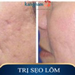 Cấy da siêu vi điểm và lăn kim – Sự khác biệt đến từ công nghệ