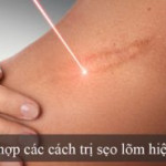 Bật mí 113 cách trị sẹo lõm mà ai cũng muốn biết