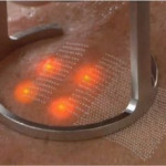 Điều trị sẹo rỗ bằng Laser: Những điều Bác sỹ da liễu chưa từng kể