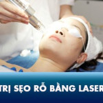 Điều trị sẹo rỗ bằng Laser Co2 Fractional có tốt không? Giá bao nhiêu tiền?