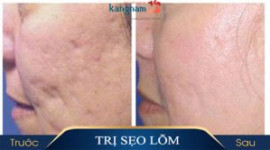 Trị sẹo lồi ở đâu tùy thuộc vào tình trạng sẹo?