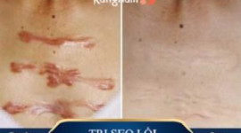 4 lưu ý cần biết về phẫu thuật cắt bỏ sẹo lồi