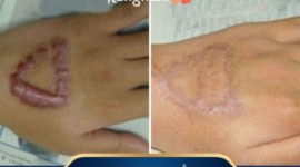 Trị Sẹo Lõm ở Kangnam GIÁ RẺ nhất là bao nhiêu? Bảng giá chữa sẹo 2019