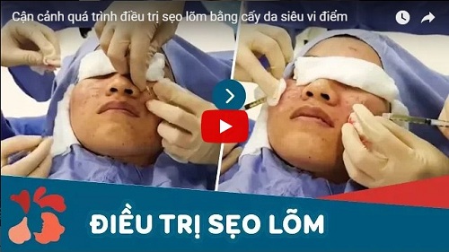 điều trị sẹo lõm sau khi tẩy nốt ruồi