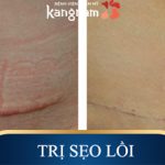 Hiệu quả vô cùng bất ngờ đến từ công nghệ trị sẹo lồi ELLA