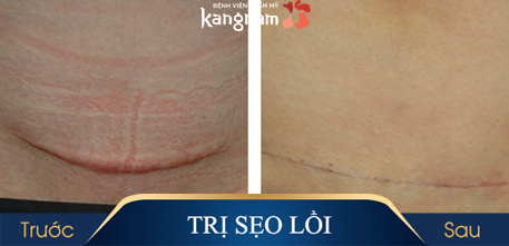 Hiệu quả vô cùng bất ngờ đến từ công nghệ trị sẹo lồi ELLA