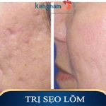 Cấy da siêu vi điểm và lăn kim – Sự khác biệt đến từ công nghệ