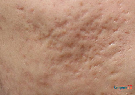 Bật mí 6 nguyên nhân gây sẹo lõm mà bạn không ngờ tới