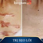 4 lưu ý cần biết về phẫu thuật cắt bỏ sẹo lồi