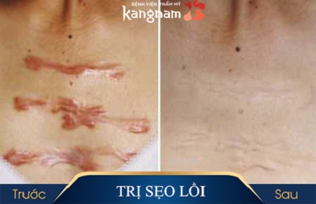 4 lưu ý cần biết về phẫu thuật cắt bỏ sẹo lồi