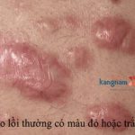 6 lý do khiến việc trị sẹo lồi là hết sức cần thiết