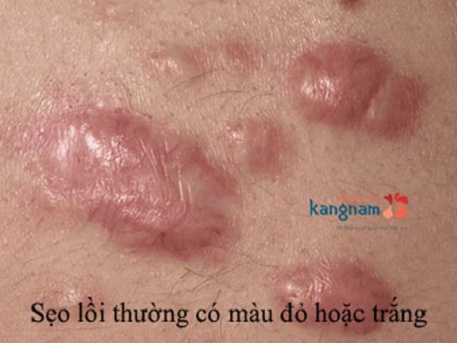 6 lý do khiến việc trị sẹo lồi là hết sức cần thiết