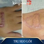 Trị sẹo lồi ở đâu tùy thuộc vào tình trạng sẹo?