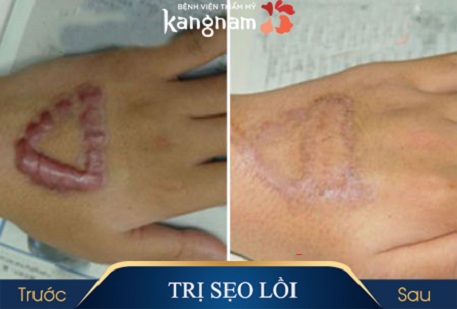 Trị sẹo lồi ở đâu tùy thuộc vào tình trạng sẹo?