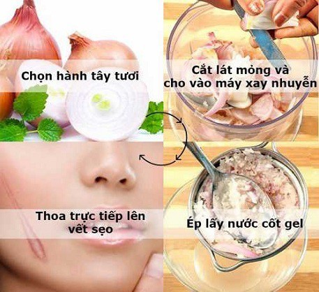 trị sẹo lồi ở đâu