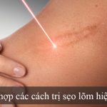 Bật mí 113 cách trị sẹo lõm mà ai cũng muốn biết