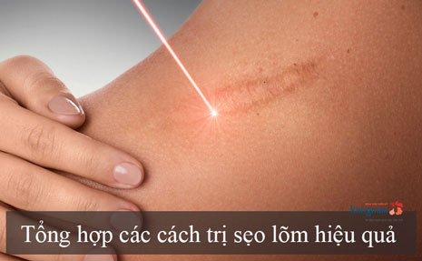 Bật mí 113 cách trị sẹo lõm mà ai cũng muốn biết