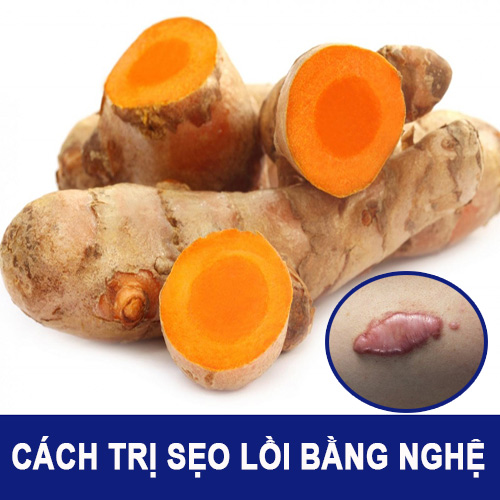 Nhận định của chuyên gia da liễu về cách trị sẹo lồi bằng NGHỆ