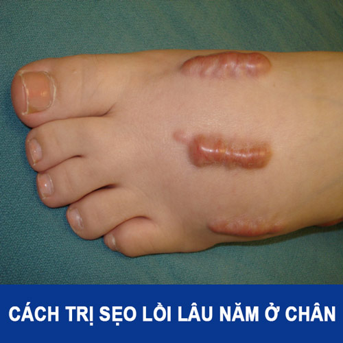Cách trị sẹo lồi lâu năm ở chân HIỆU QUẢ SIÊU NHANH với 6 nguyên tắc sau