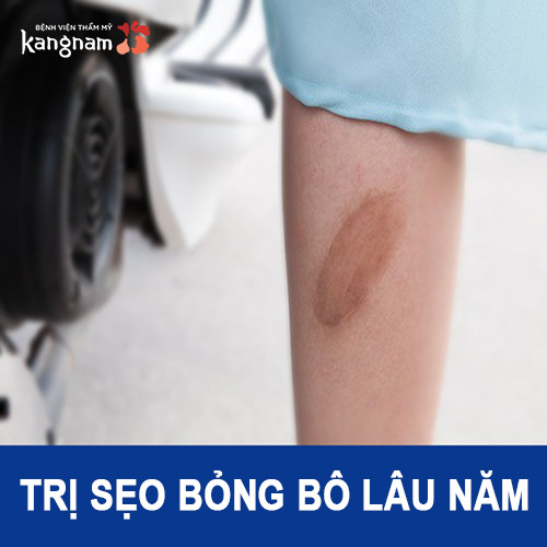 Chữa trị sẹo bỏng bô lâu năm – Điều trị tưởng không dễ mà lại dễ không tưởng!