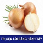 Cách trị sẹo lồi bằng hành tây có thực sự hiệu quả – Lắng nghe ý kiến của chuyên gia