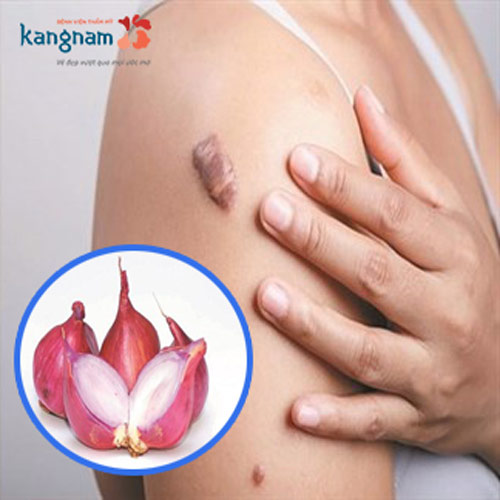 Bỏ túi cách trị sẹo lồi bằng hành tím: Đơn giản mà hiệu quả không ngờ!