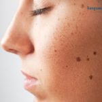 Bỏ túi ngay 3 cách trị sẹo lõm sau khi tẩy nốt ruồi hiệu quả nhất hiện nay