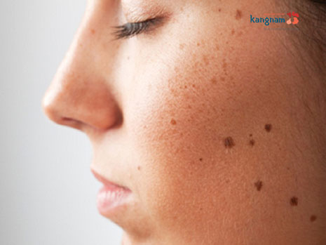 Bỏ túi ngay 3 cách trị sẹo lõm sau khi tẩy nốt ruồi hiệu quả nhất hiện nay