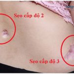 TÌM HIỂU NGAY 3 cách điều trị sẹo lõm lâu năm ở chân siêu hiệu quả