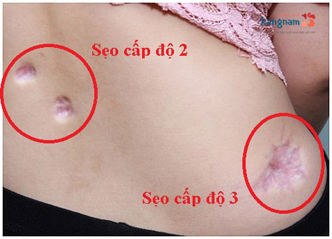 TÌM HIỂU NGAY 3 cách điều trị sẹo lõm lâu năm ở chân siêu hiệu quả