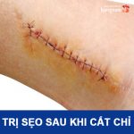 Hướng dẫn cách trị sẹo sau khi cắt chỉ đạt hiệu quả tốt nhất