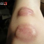 Chia sẻ cách Trị Sẹo Lồi ở Đầu Gối đơn giản – Hiệu quả ngay sau 5 tuần