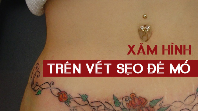 hình xăm che vết sẹo mổ