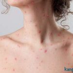 Chia sẻ hành trình chữa trị sẹo lồi ở ngực thành công của bà mẹ U30