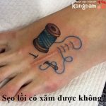 Sẹo lồi có xăm được không? Lời khuyên tốt nhất cho người bị sẹo lồi
