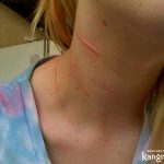 TOP 3 CÁCH TRỊ SẸO LỒI Ở CỔ PHÙ HỢP VỚI “TUỔI THỌ” CỦA SẸO