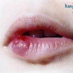Sẹo lồi ở môi có thực sự khó chữa trị? Đi tìm giải pháp là sẹo môi hiệu quả nhất!