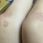 14 Cách trị sẹo ở thâm ở chân lâu năm- Xóa sẹo NHANH, hiệu quả nhất
