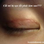 Cắt mí bị sẹo lồi phải làm sao? Cơ địa sẹo lồi có cắt mí được không?