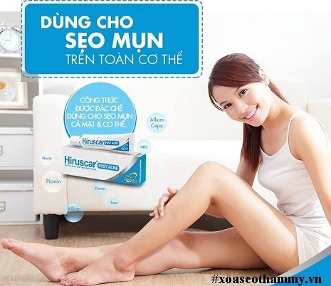 kem trị sẹo bỏng nước sôi