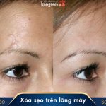 Sẹo trên lông mày là tốt hay xấu? Mách bạn 3 cách giấu sẹo hiệu quả
