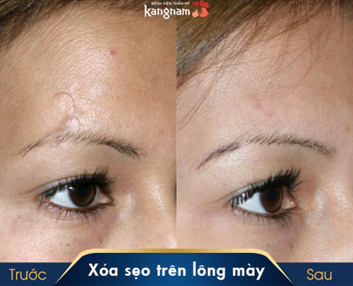 Sẹo trên lông mày là tốt hay xấu? Mách bạn 3 cách giấu sẹo hiệu quả