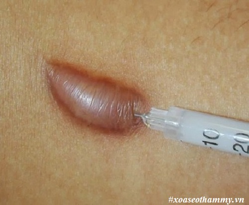 Tiêm sẹo lồi có hiệu quả không? Phân tích cụ thể 2 mặt lợi và hại