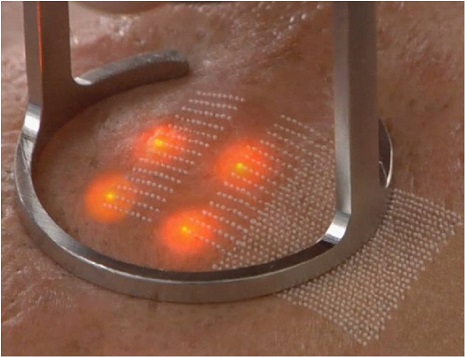 Điều trị sẹo rỗ bằng Laser: Những điều Bác sỹ da liễu chưa từng kể