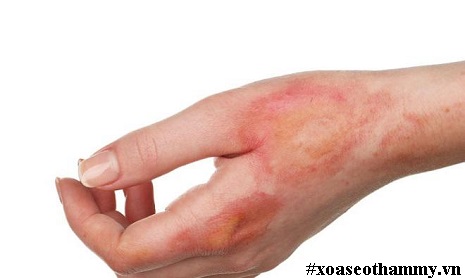 Review TOP 3 phương pháp trị sẹo bỏng nước sôi hiệu quả nhất hiện nay