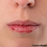 Phương pháp xóa sẹo sứt môi hiệu quả 100% được các chuyên gia khuyên dùng