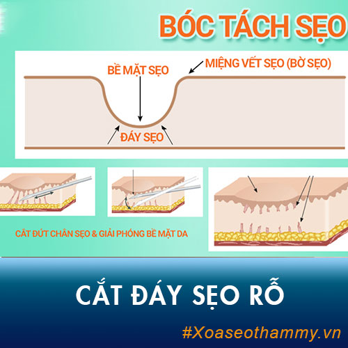 [Hé lộ] Những điều chưa biết về phương pháp cắt đáy sẹo rỗ