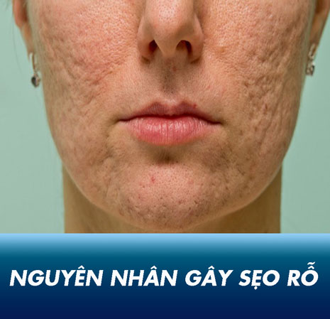 4 nguyên nhân gây sẹo rỗ (lõm) trên mặt KINH ĐIỂN mà bạn cần phải biết!