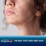 Đập tan ám ảnh sẹo thủy đậu lâu năm nhờ áp dụng “mẹo” dân gian